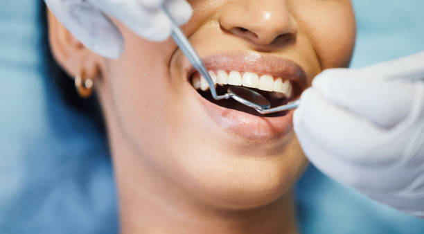 Best Emergency Dentist for Lost Fillings or Crowns in Holley, NY