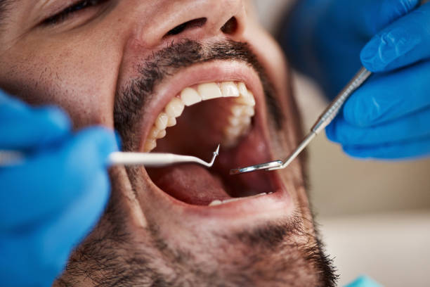 Best Emergency Dentist for Lost Fillings or Crowns in Holley, NY